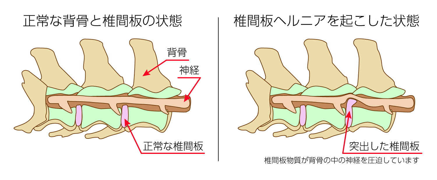 正常な背骨と椎間板の状態と椎間板ヘルニアを起こした状態