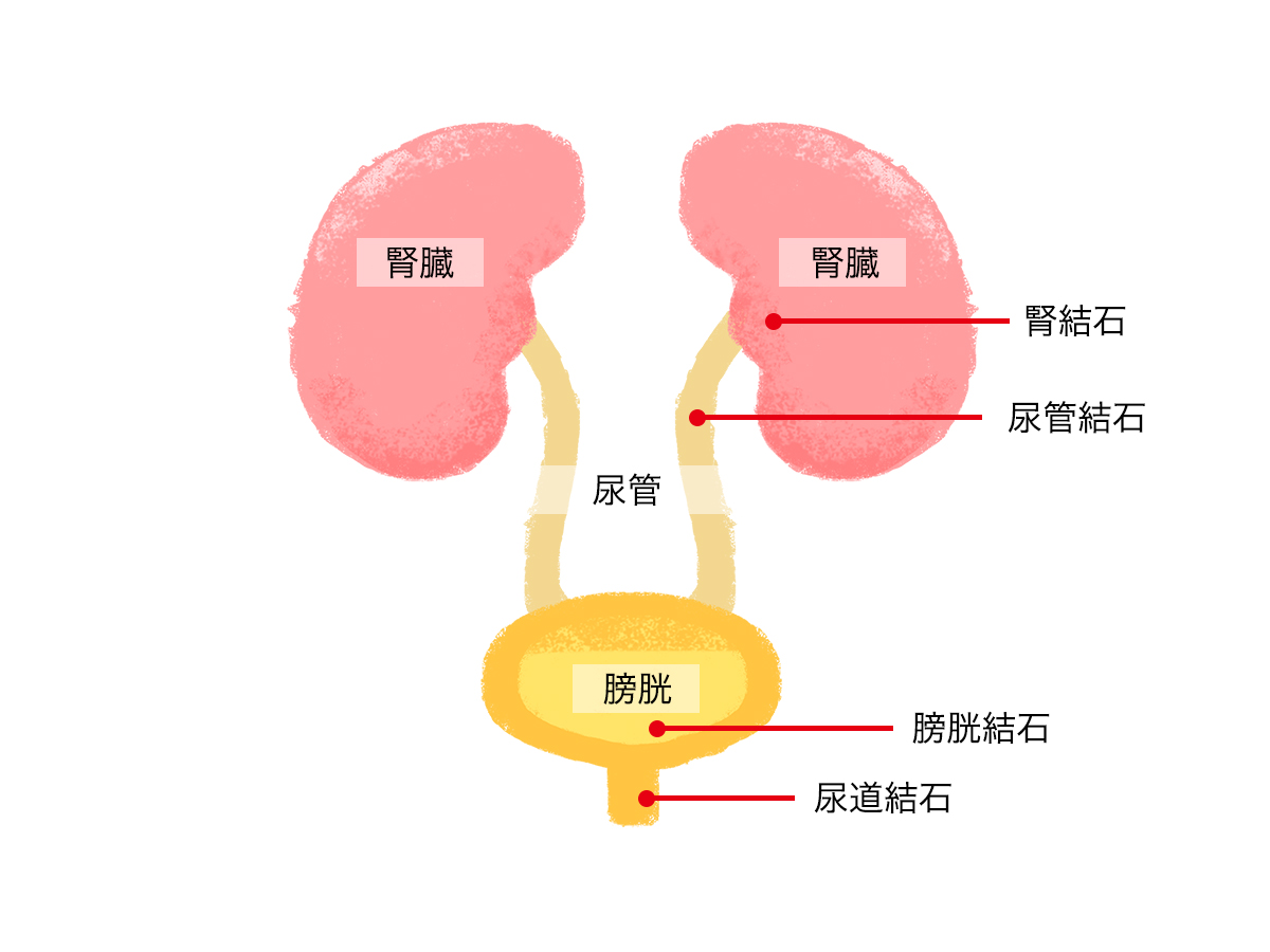 腎臓から尿道までの間のどの場所にも、結石ができる可能性があります。